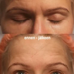 Faceimage kinesioteippi herkälle iholle, 2 eri kokoa